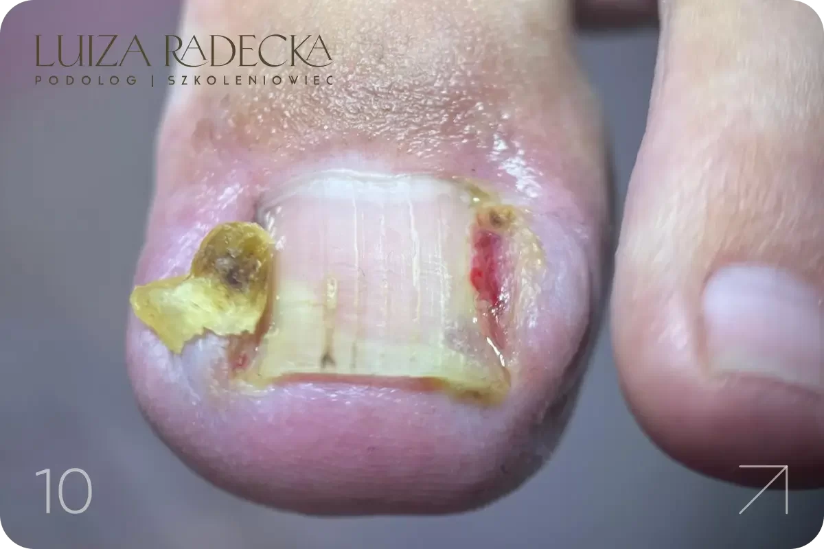 Szkolenie podologiczne - wrastające paznokcie